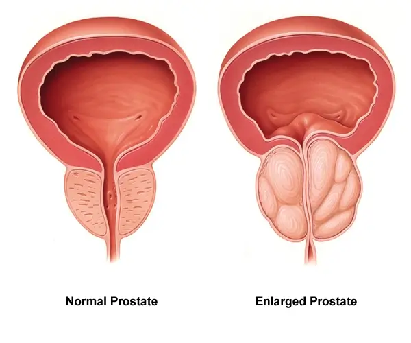 Prostodine Prostate Health 